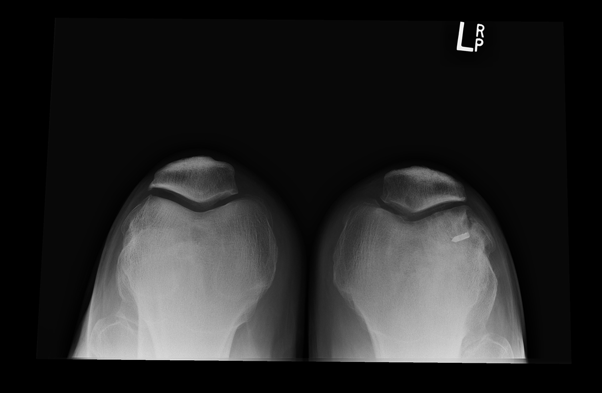 Patellar Dislocation Differences SHELBOURNE KNEE CENTER patellar-dislocation-differences-shelbourne-knee-center